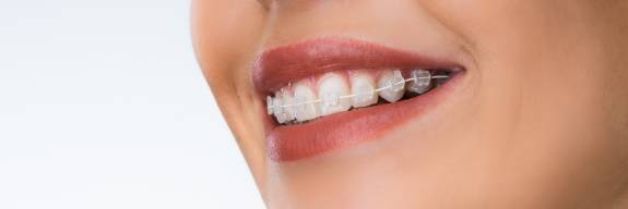 Nahansicht des Lächelns einer Frau mit Zahnspange